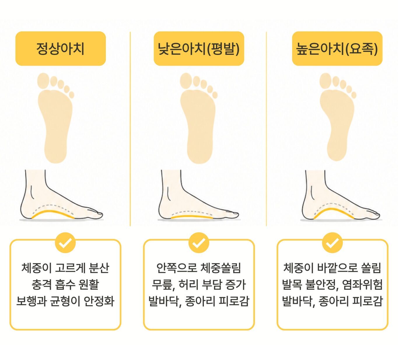 정상 아치 낮은 아치 평발 높은 아치 요족 비교 안내