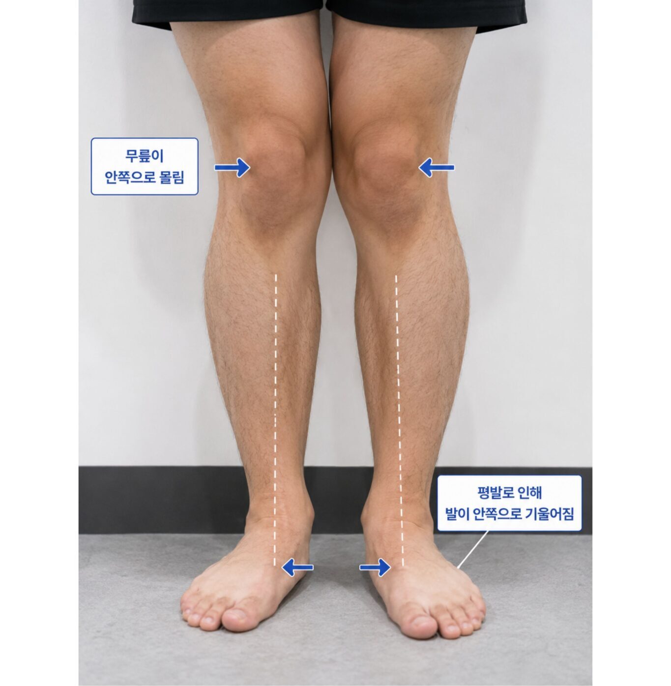무릎이 안쪽으로 모이고 발이 안쪽으로 기울어진 하지 정렬 안내