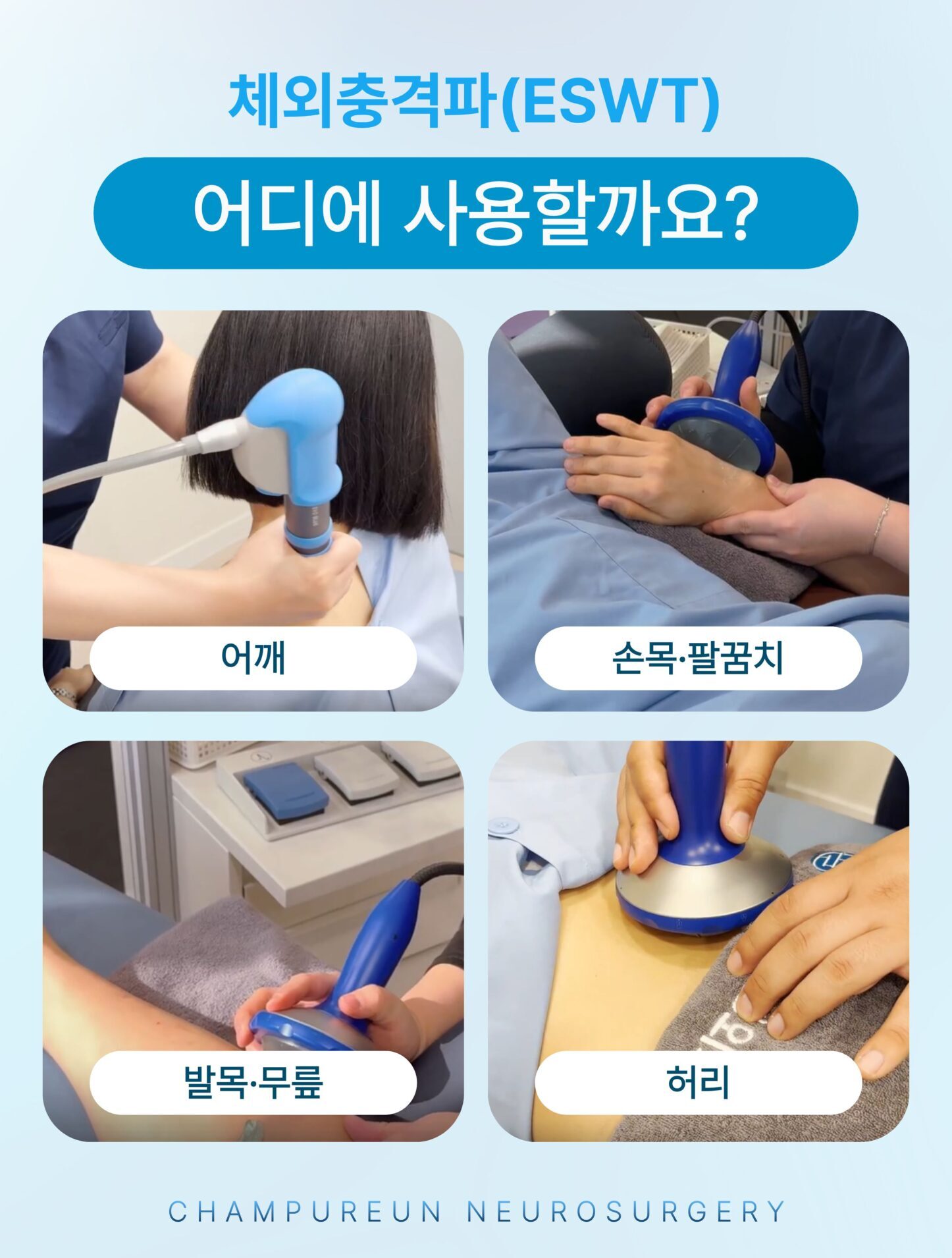 체외충격파 ESWT 어깨 손목 팔꿈치 발목 무릎 허리 적용 부위 안내